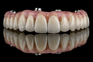 Bone Grafting