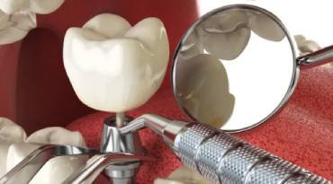 Teeth implants in Fort Worth