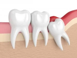 Wisdom Teeth Removal Fort Worth