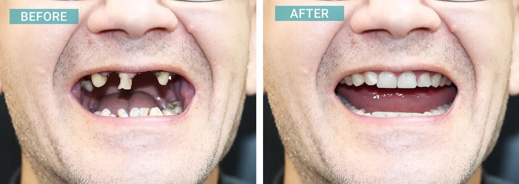 Dental implant in Fort Worth