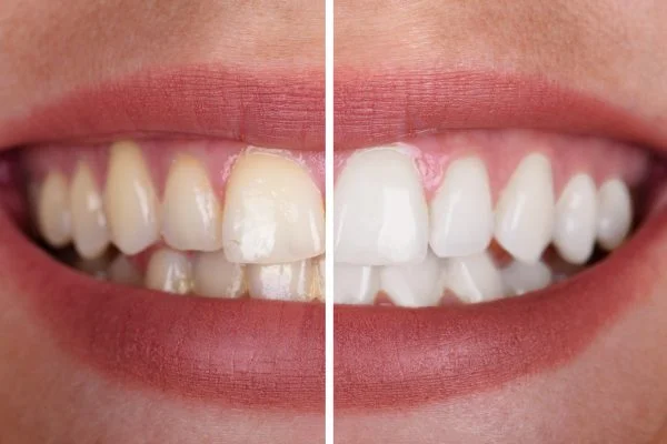 Teeth whitening Fort Worth