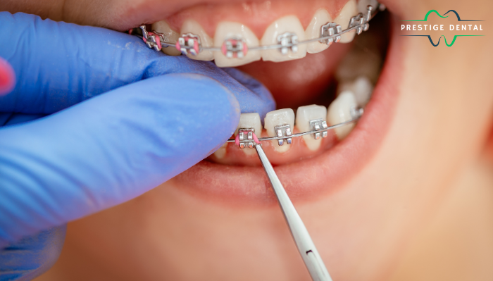 5 Indications You May Require Braces