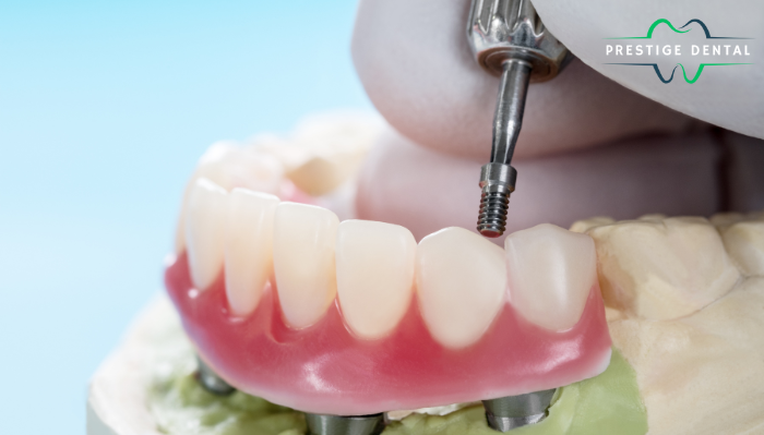 Transform Your Smile with the Best Dental Implants in Fort Worth